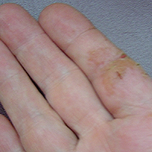 Skin Allergy - blisters and cracking