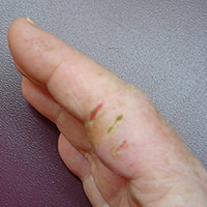 Skin allergy - rght hand, side view