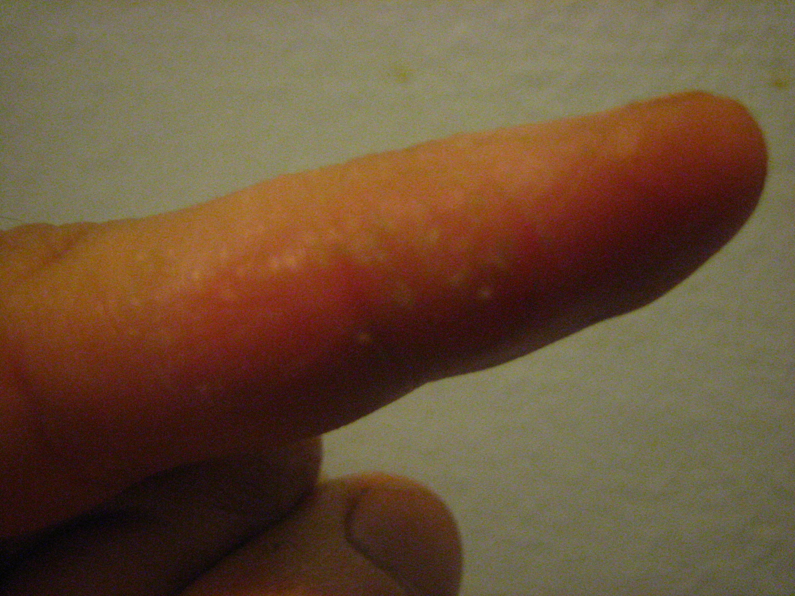 contact dermatitis?