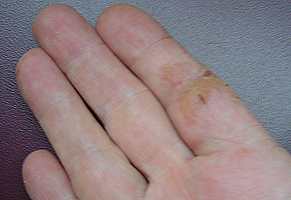 Skin Allergy - blisters and cracking