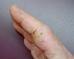 Skin allergy - rght hand, side view